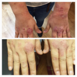 手荒れが改善されたお客様